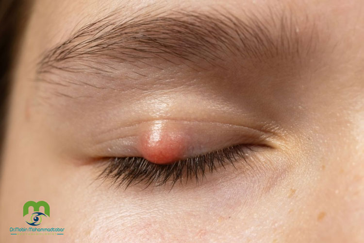 شالازیون و روش های درمان