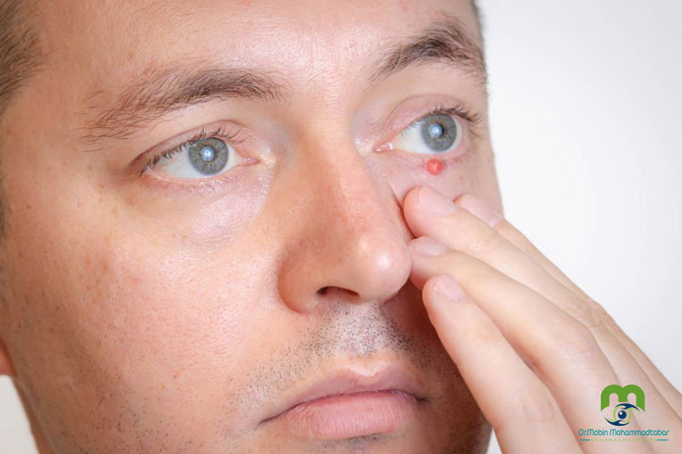 دلایل ایجاد کیست های چشمی