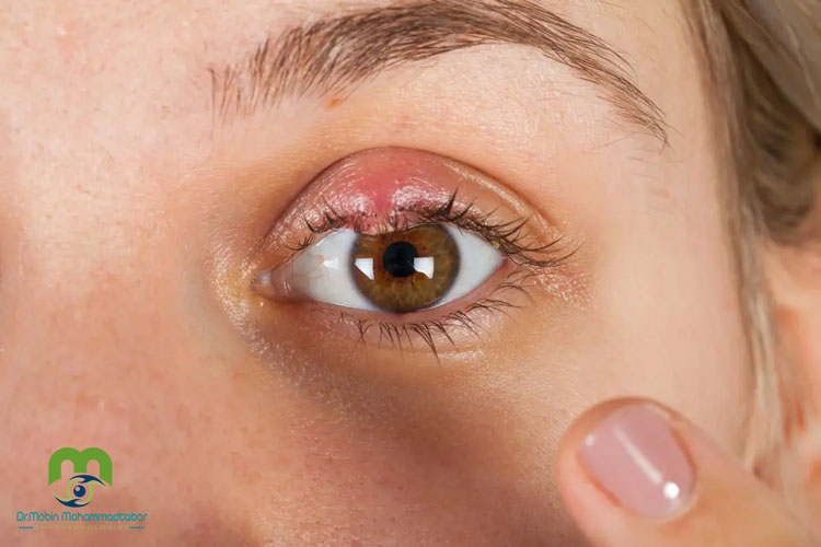 گل مژه و روش های درمان