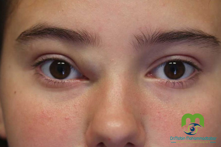 کیست درموئید و روش های درمان