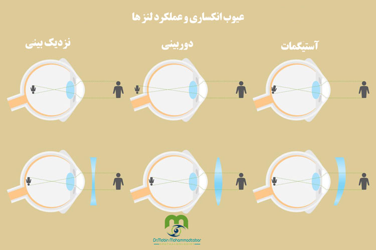 ایجاد آستیگمات