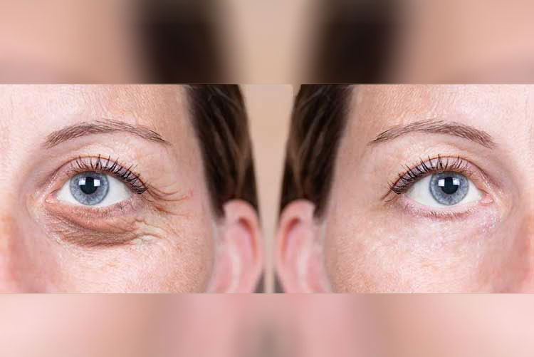 تکنیک جدید جوانسازی پلک