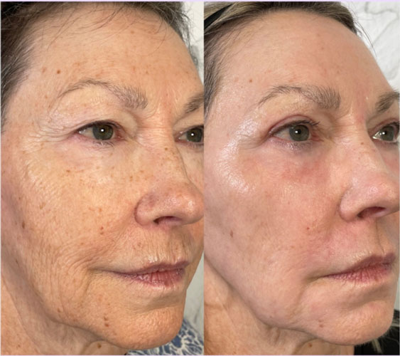 روش نوین جوانسازی ناحیه چشم