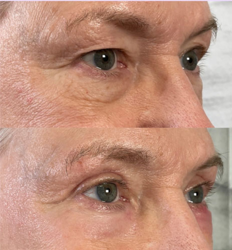 روش نوین جوانسازی ناحیه چشم