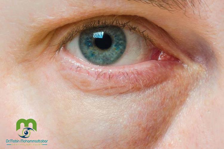 مراقبت های بعد از بلفاروپلاستی از داخل