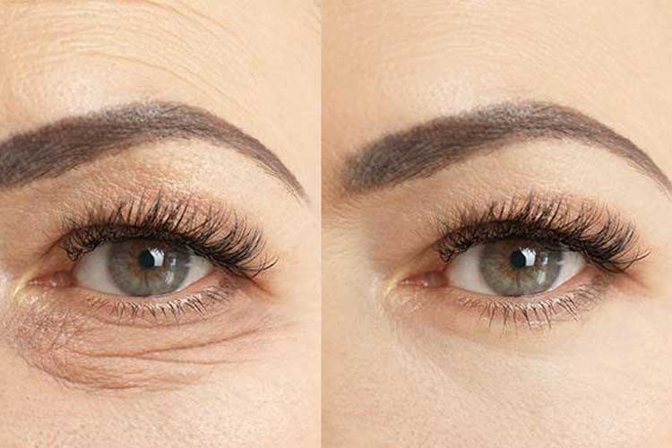 بلفاروپلاستی از داخل پلاک