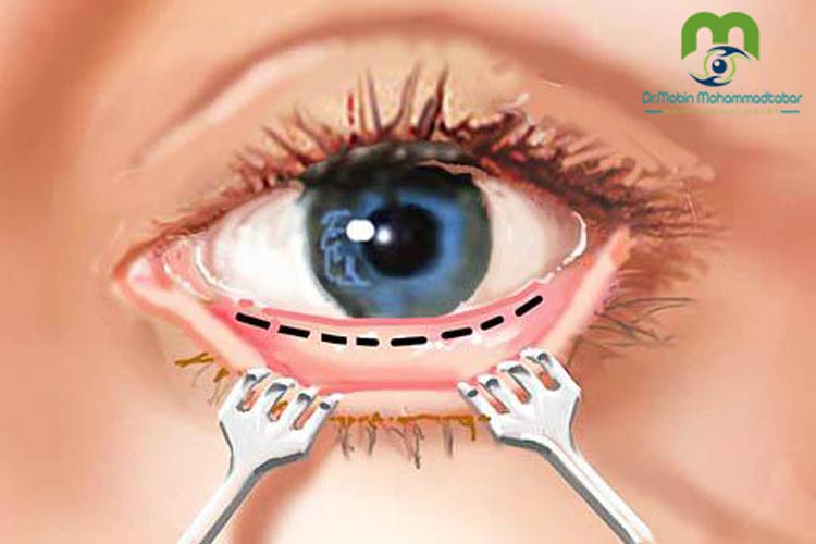 بلفاروپلاستی پلک از داخل