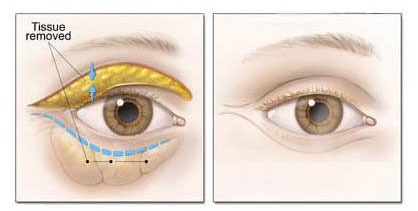 بهبود دید با بلفاروپلاستی