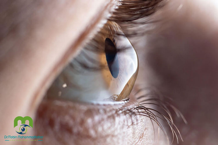 عمل لیزیک برای قوز قرنیه