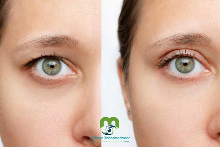 بلفاروپلاستی از روی پوست