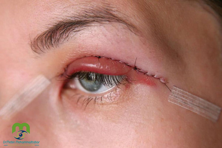 بلفاروپلاستی پلک بالا از روی پوست