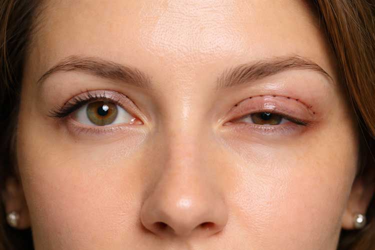 کوچک شدن چشم بعد از بلفارو