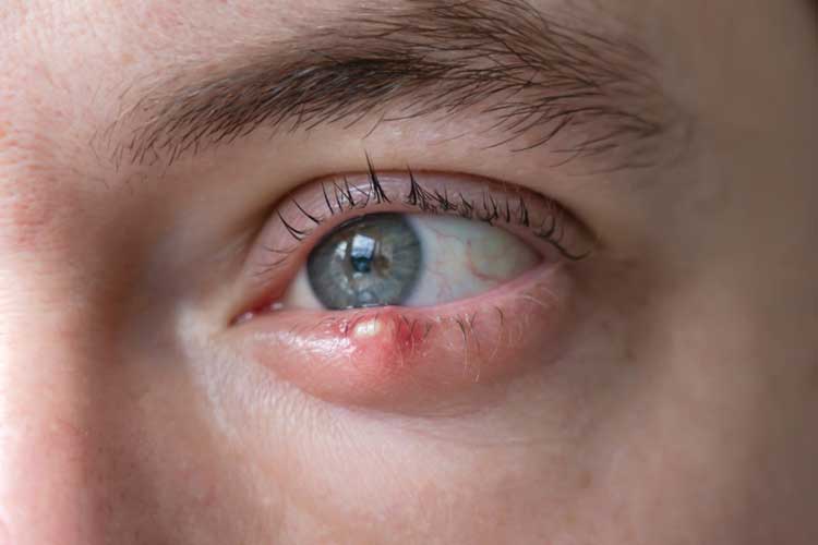 گل مژه چیست؟