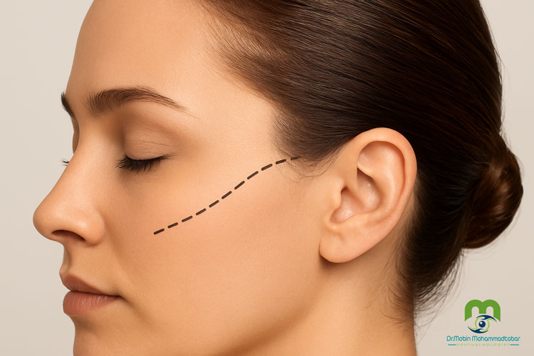 لیفت شقیقه به روش جراحی