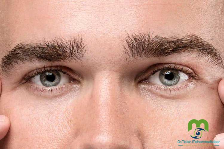 بلفاروپلاستی برای آقایان