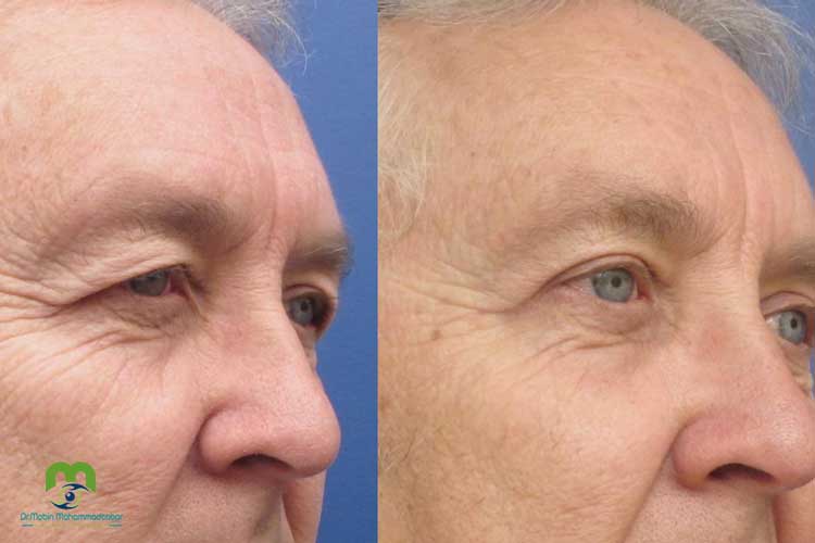 بلفاروپلاستی در مردان