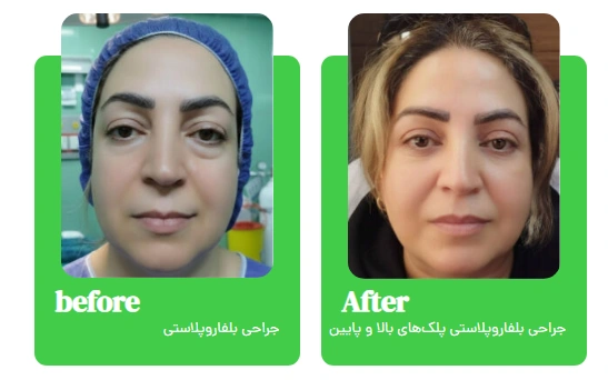 بلفارو پلاستی 