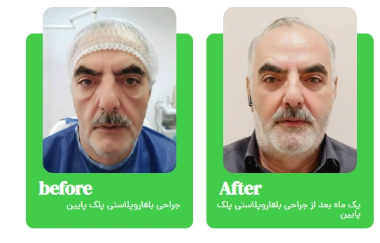 هزینه بلفاروپلاستی